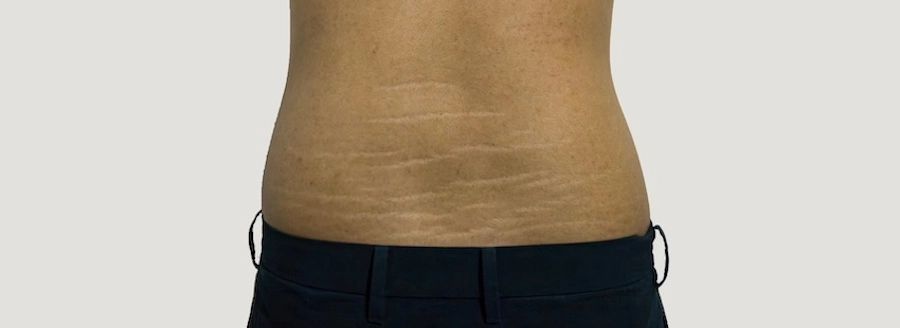 This male needs stretch mark therapy due to the stretch marks on his lower back.