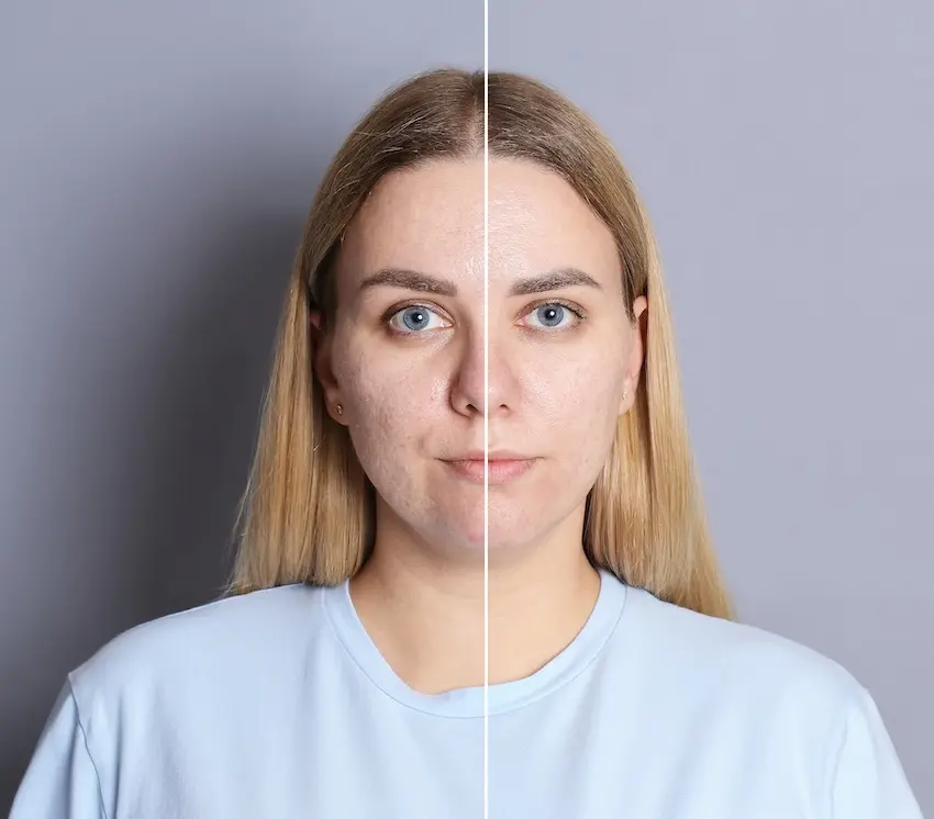 Before and after comparison showing sun damage and uneven skin tone improvement following MOXI laser treatment